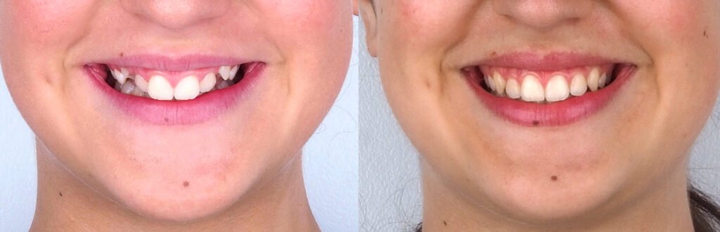 caso de ortodoncia en madrid antes y despues apiñamiento