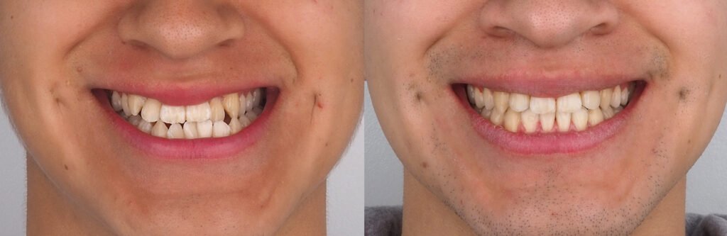 caso de ortodoncia en madrid antes y despues mordida cruzada