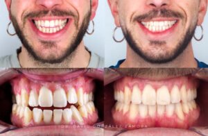 caso de ortodoncia en madrid antes y despues mordida cruzada