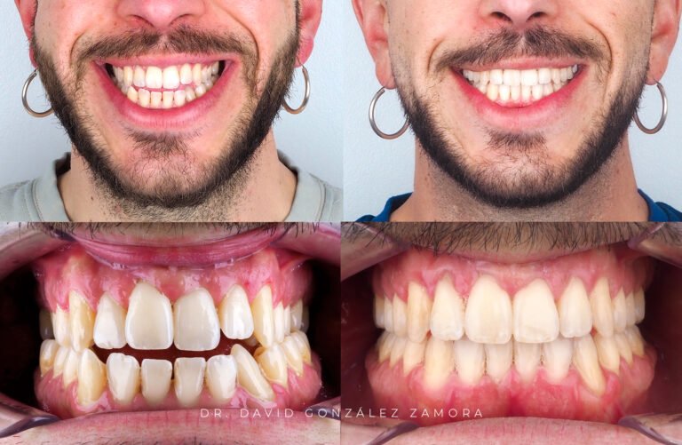 caso de ortodoncia en madrid antes y despues mordida cruzada