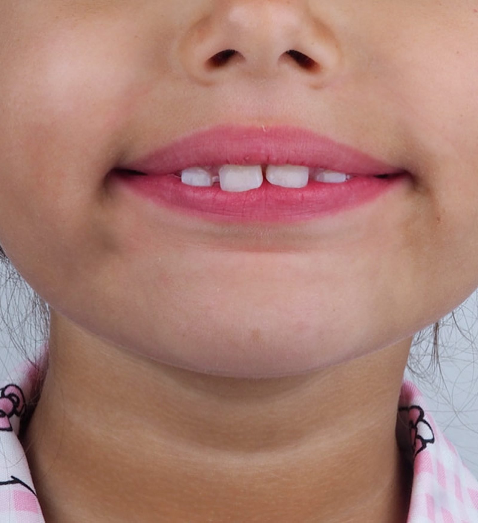 Ortodoncia-infantil-madrid