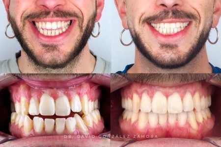 caso de ortodoncia en madrid antes y despues mordida cruzada