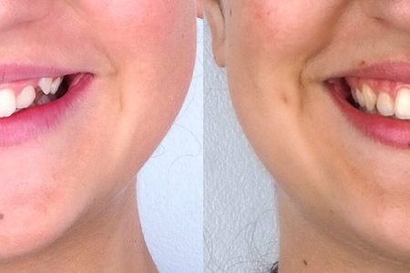 caso de ortodoncia en madrid antes y despues apiñamiento
