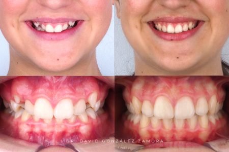 caso de ortodoncia en madrid antes y despues apiñamiento