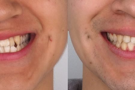 caso de ortodoncia en madrid antes y despues mordida cruzada