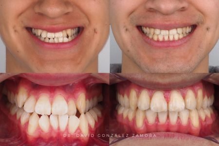 caso de ortodoncia en madrid antes y despues mordida cruzada